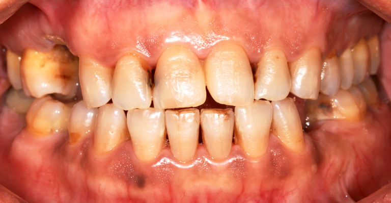 Depending on the stage of decay, meth mouth can make teeth appear stained, blackened, or rotten. As the teeth become more damaged, they can be worn down into nubs as they are eaten away by bacteria and acid.