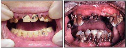 What does a meth addict look like? and why do meth addicts lose their teeth? A common sign of meth addiction is extreme tooth decay, which has created the term "Meth Mouth." Above are the before and after pics of meth addicts and meth mouth signs and symptoms.