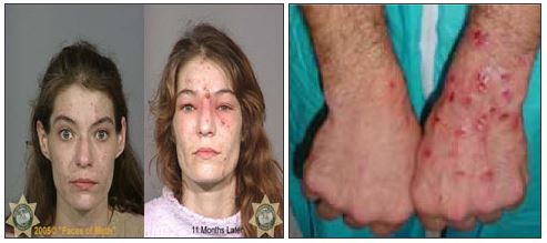 Meth addicts face and skin sores are a side effect of meth addiction as shown in the meth addict pics, images of meth addicts, and meth addict photos.
