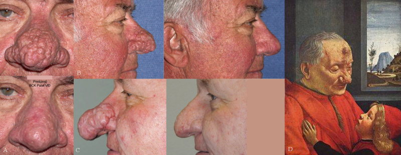 Alcoholic Nose Images. According to the NCBI, Rhinophyma (Greek “nose growth,” Slang "alcoholic nose") is a benign skin deformity characterized by tumorous growth leading to a large, bulbous, and erythematous appearing nose.