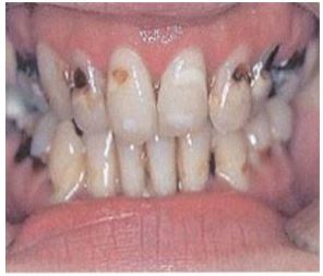 Meth addiction can start to take over a person’s life in a very short period of time. Meth addiction photos of "meth Mouth" show how meth drugs can also cause physical adverse effects.