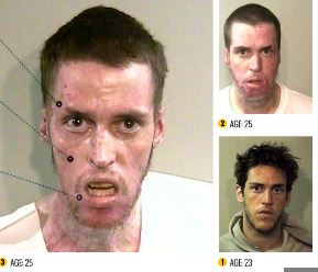 Pictures of meth addicts before and after. One of the most striking physical effects of meth use is the damage it can cause to the teeth and mouth. Meth addicts may experience rapid tooth decay, gum disease, and tooth loss. Their teeth may appear blackened or stained, and their breath may have a foul odor. This condition is commonly referred to as "meth mouth" as shown in these meth addicts before and after pictures.