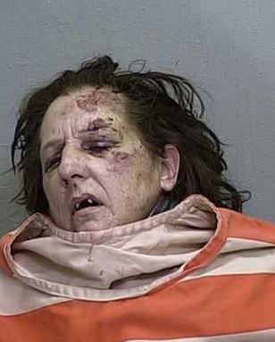 The physical effects of methamphetamine use are not limited to the face and mouth. Chronic use of the drug can cause significant weight loss, with a noticeable decrease in muscle mass and body fat. Meth addicts by this meth addicts pictures may appear frail and weak, with sunken chests and visible ribs. They may also suffer from hair loss, skin infections, and other physical ailments.