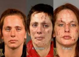 Meth use can cause premature aging, with meth addicts often appearing much older than their actual age due to the damage caused to their skin, teeth, and overall health as shown by this meth addiction before and after picture