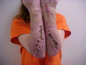Pics of meth addicts. Meth scabs are typically found on the face, arms, and legs and can range in size from small, red bumps to larger, more severe wounds. They can be unsightly and may also be painful, itchy, or prone to infection.