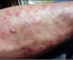 Meth mites pictures. This phenomenon is often referred to as "formication," which is a term used to describe the sensation of bugs or insects crawling on or under the skin.