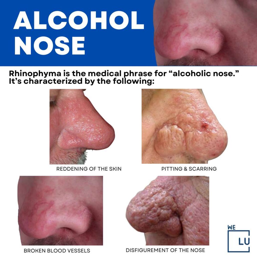 Alcohol intolerance can sometimes manifest as nasal symptoms. This may include facial flushing, redness, or congestion of the nasal passages after consuming alcohol, particularly in individuals who have difficulty metabolizing alcohol.