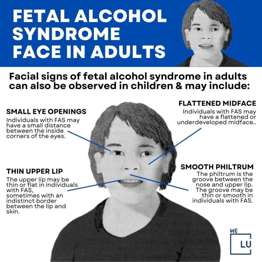 The above chart on “Fetal Alcohol Syndrome in Adults” Shows the facial signs of Fetal Alcohol Syndrome.