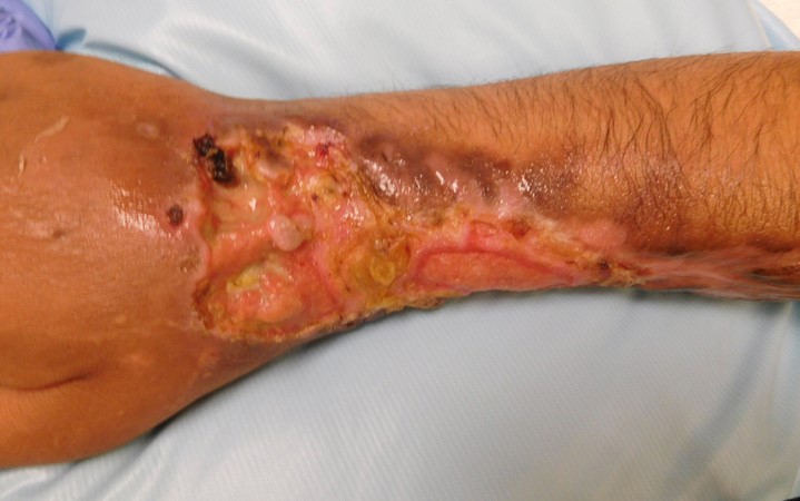 Krokodil drug pictures featured above. Image shows Krokodil drug induced deep ulceration of the right forearm with nearly exposed tendon. Source: NIH.
