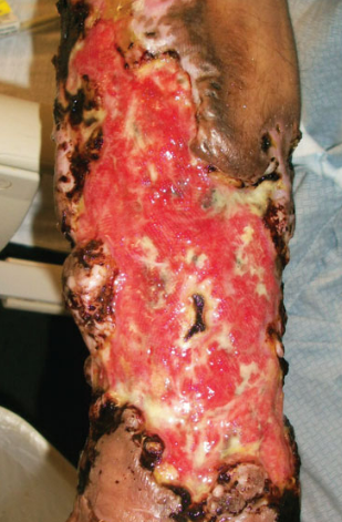 The term "Zombie Drug Skin Rot" is sometimes used colloquially to describe the visible physical effects that krokodil use can have on a person's skin and flesh. 