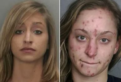 Photos of meth addicts. "Meth sores" is another colloquial term used to describe a common symptom experienced by some methamphetamine users. These sores are typically small, red, and inflamed, and may resemble acne or other types of skin lesions as shown in this meth addict pictures before and after.